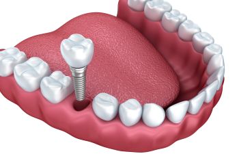 Dental implant