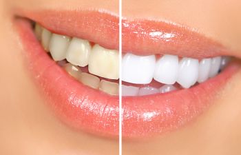 Woman's teeth before and after whitening